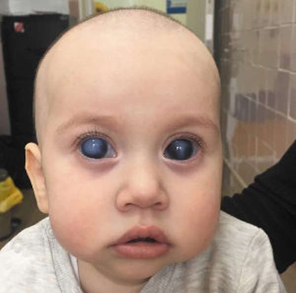 врожденная глаукома у детей